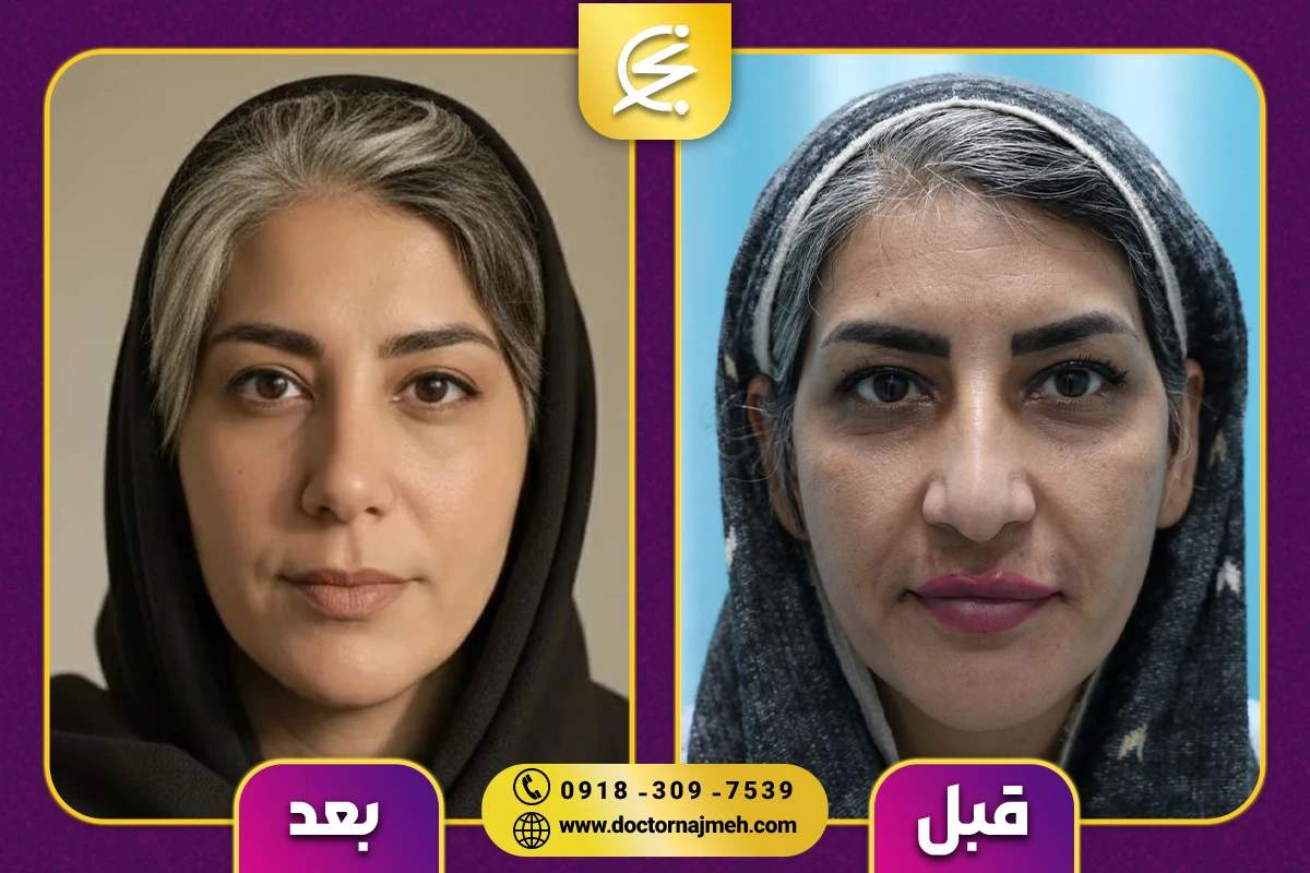 نمونه کار جراحی بینی دکتر نجمه برخورداری کرمانشاه