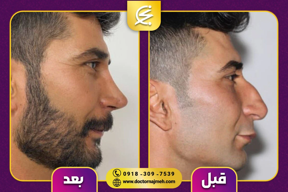نمونه کار جراحی بینی دکتر نجمه برخورداری کرمانشاه