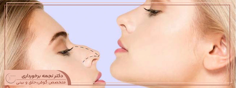 عمل زیبایی بینی