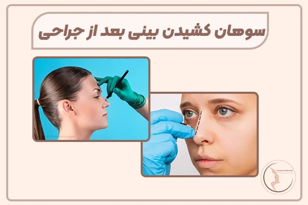 سوهان کشیدن بینی + سوهان کشی بعد از عمل