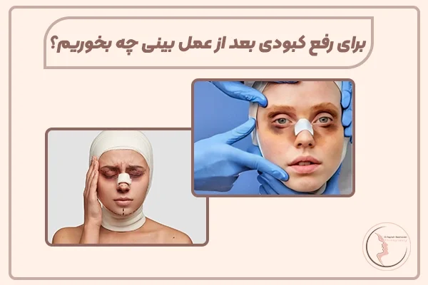 کبودی بعد عمل بینی
