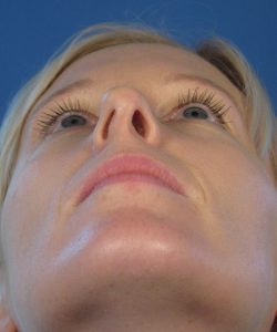 عدم تقارن سوراخ‌های بینی