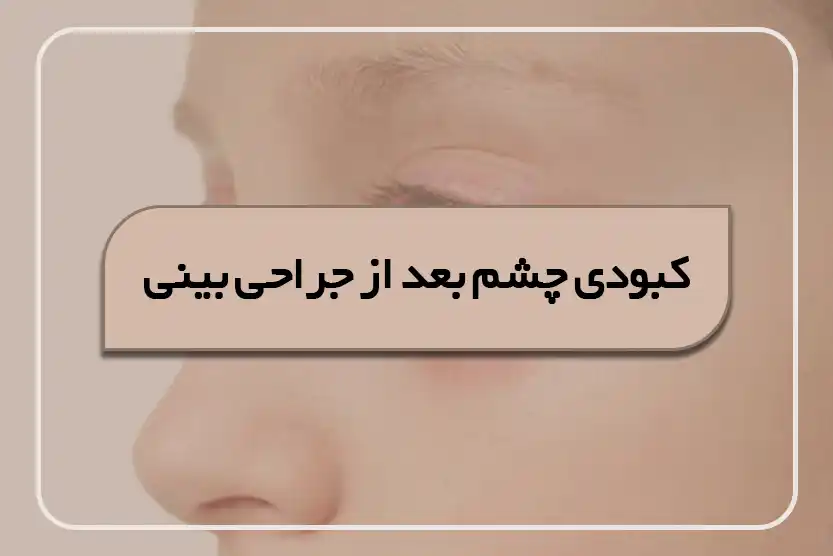 کبودی چشم بعد از جراحی بینی