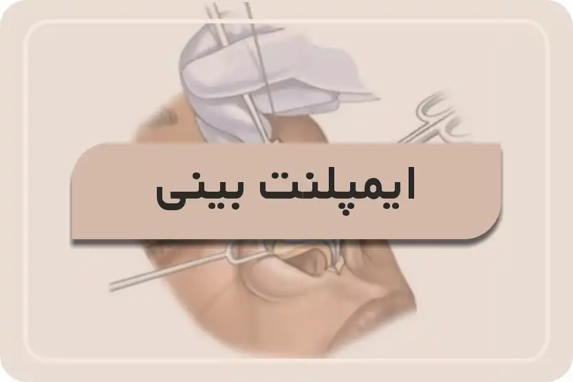 ایمپلنت بینی