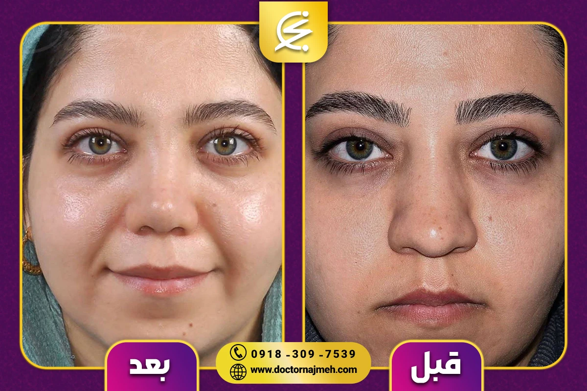 نمونه کار جراحی بینی دکتر نجمه برخورداری کرمانشاه