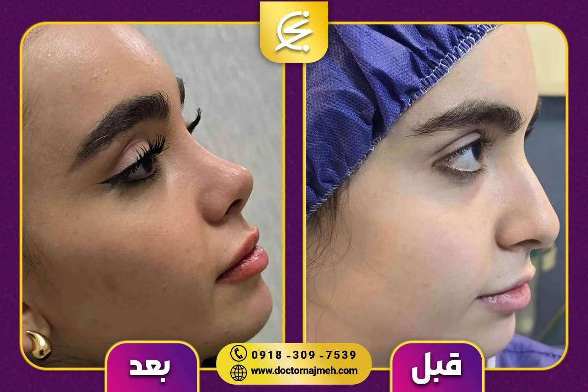 نمونه کار جراحی بینی دکتر نجمه برخورداری کرمانشاه