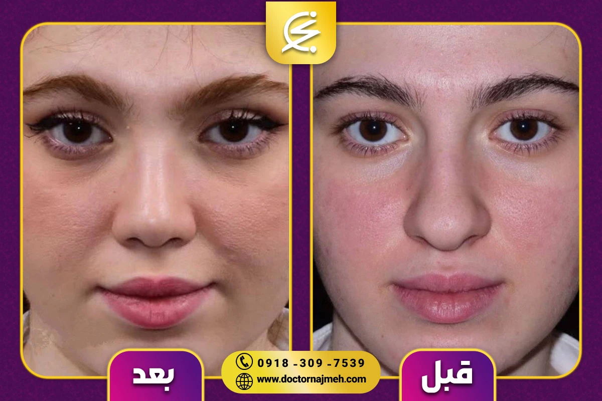نمونه کار جراحی بینی دکتر نجمه برخورداری کرمانشاه