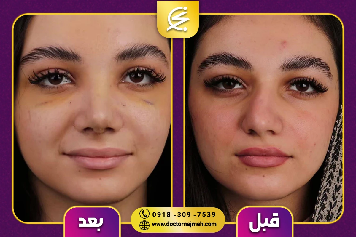 نمونه کار جراحی بینی دکتر نجمه برخورداری کرمانشاه