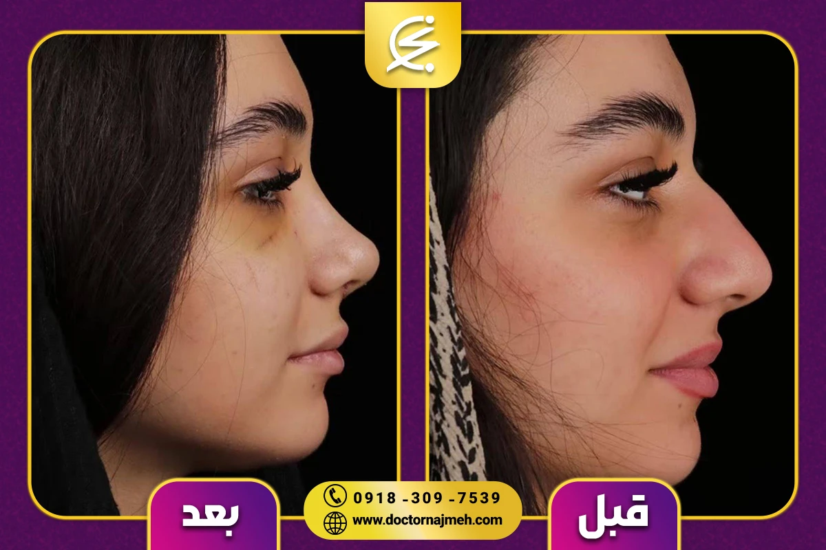 نمونه کار جراحی بینی دکتر نجمه برخورداری کرمانشاه