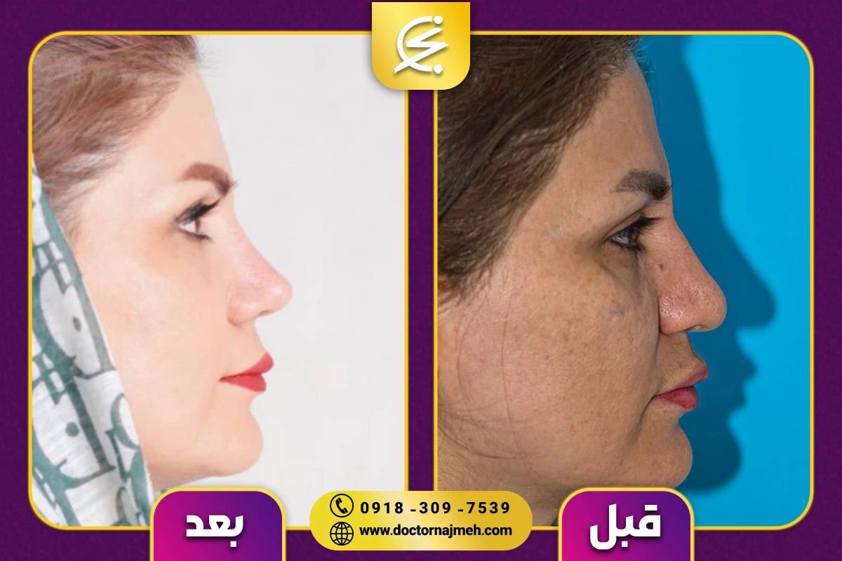 نمونه کار بهترین جراح بینی در کرمانشاه - دکتر نجمه برخورداری
