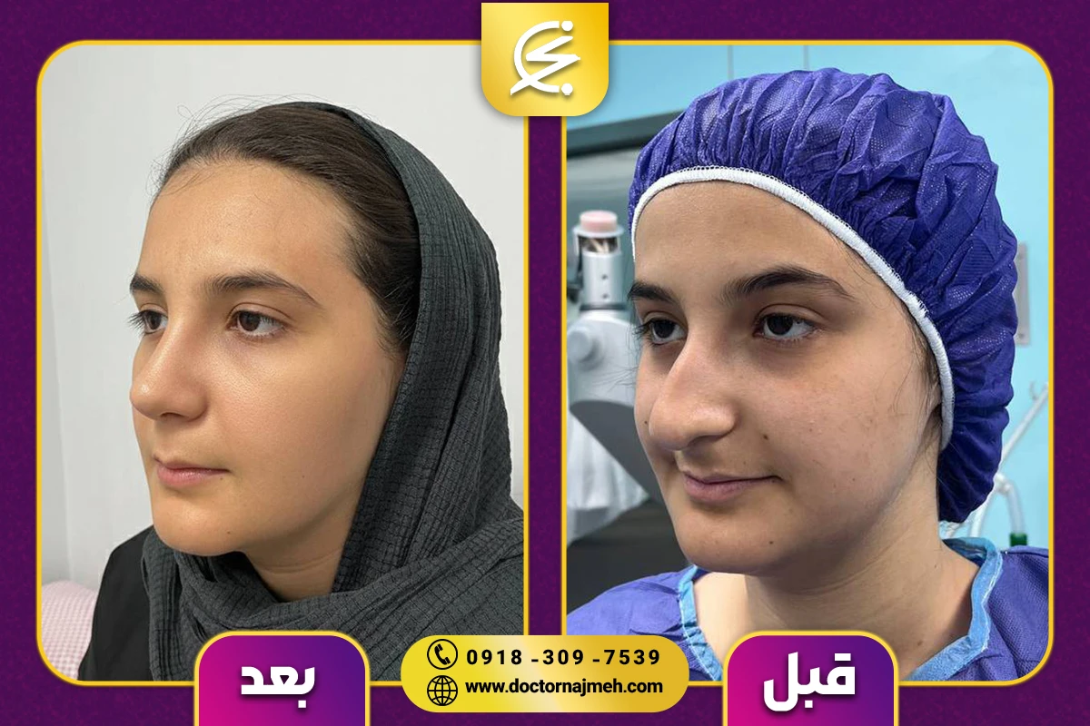 نمونه کار بهترین جراح بینی در کرمانشاه - دکتر نجمه برخورداری