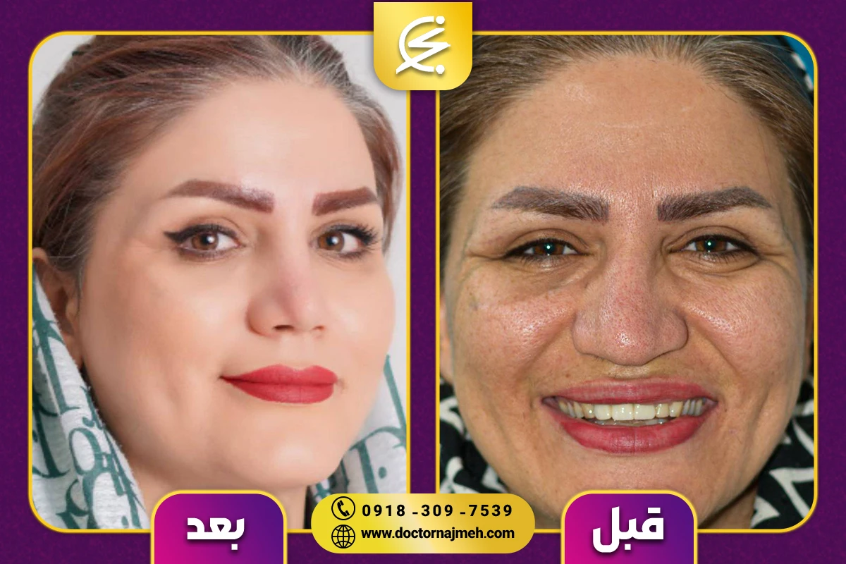 نمونه کار بهترین جراح بینی در کرمانشاه - دکتر نجمه برخورداری