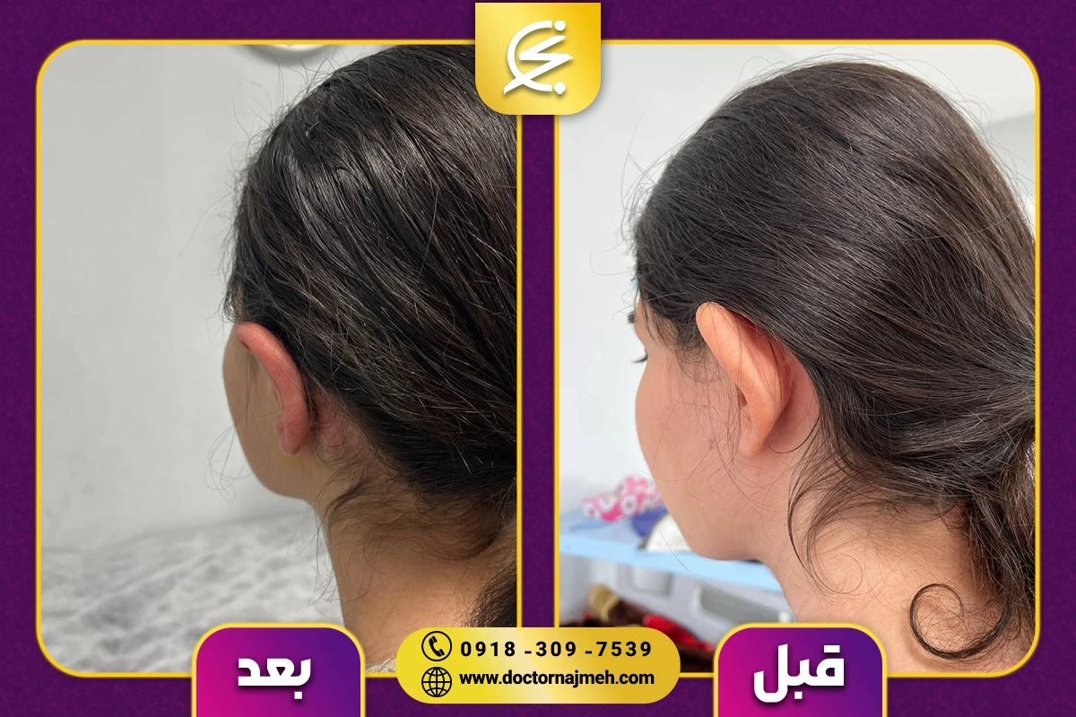 نمونه کار جراحی زیبایی گوش در کرمانشاه توسط بهترین جراح زیبایی گوش کرمانشاه - دکتر نجمه برخورداری