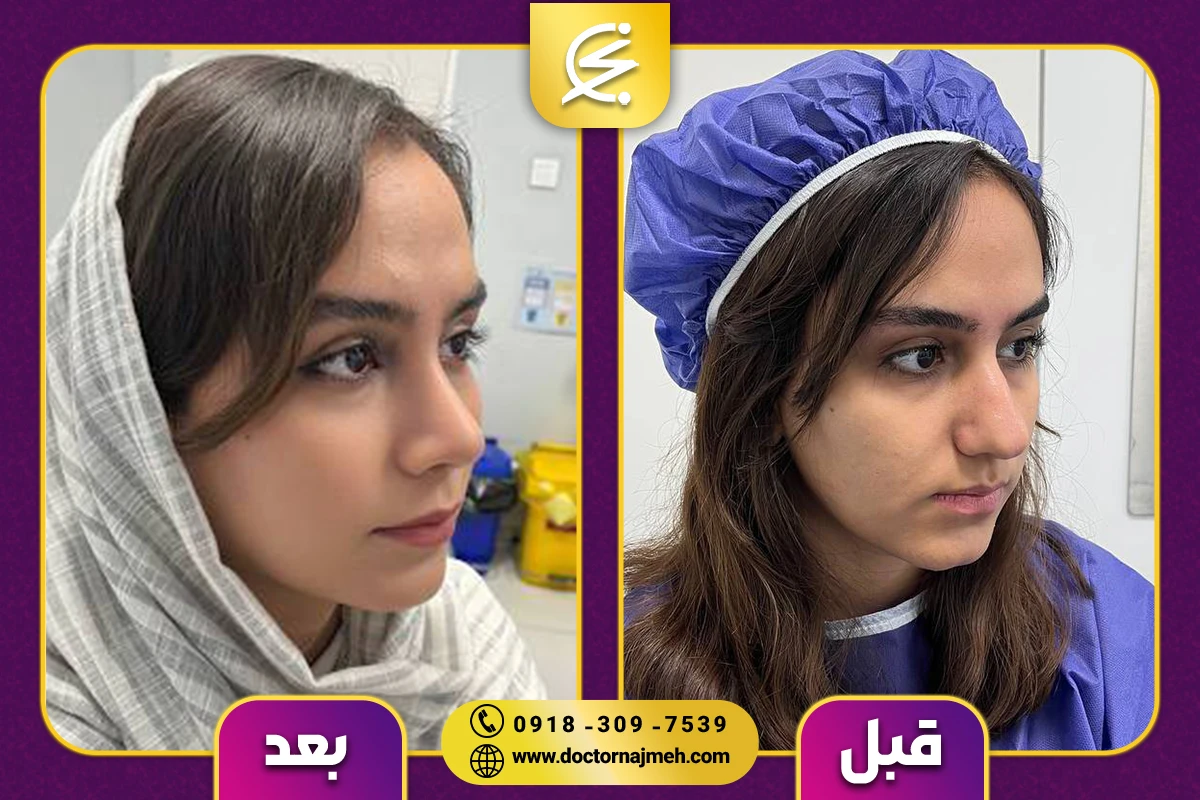 نمونه کار بهترین جراح بینی در کرمانشاه - دکتر نجمه برخورداری