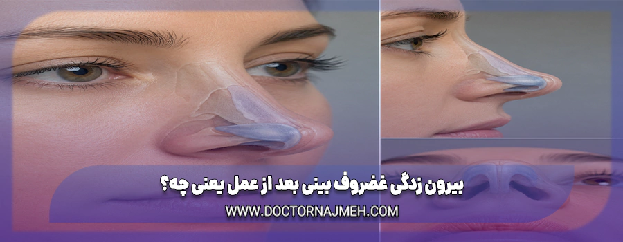 بیرون زدگی غضروف بینی بعد از عمل یعنی چه؟