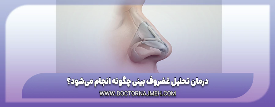 درمان تحلیل غضروف بینی با بازسازی غضروف