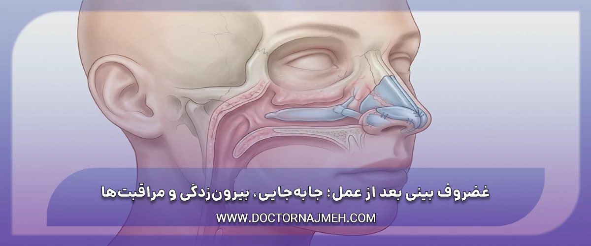 غضروف بینی بعد از عمل؛ جابه‌جایی، بیرون‌زدگی و مراقبت‌ها