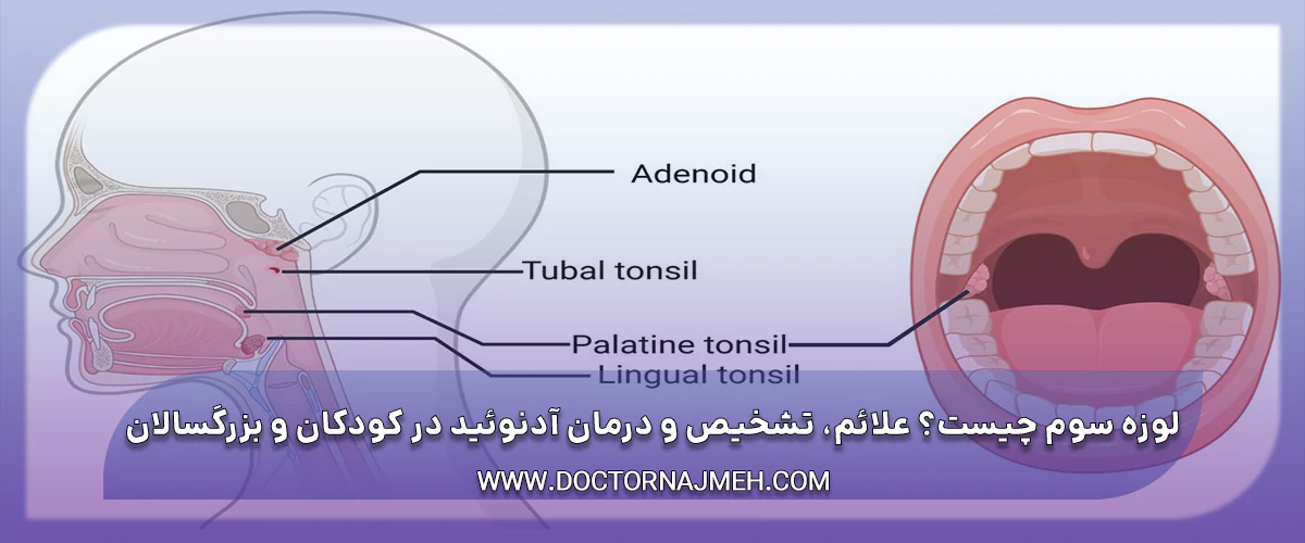 لوزه سوم چیست؟ علائم، تشخیص و درمان آدنوئید در کودکان و بزرگسالان