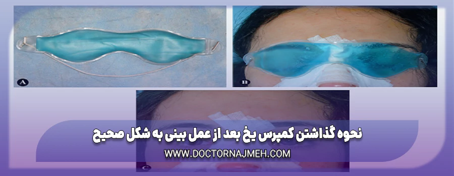 نحوه گذاشتن کمپرس یخ بعد از عمل بینی به شکل صحیح